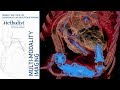 Imaging the Patient with LVAD (Mahwash Kassi, MD and Su Min Chang, MD) February 5, 2019