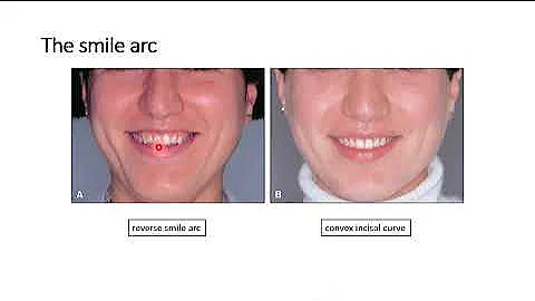 Fixed Prosthodontics 8 ; Lec 1 ; Esthetic Considerations