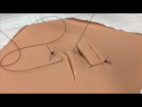 Parallel Lacerations