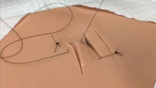 Parallel Lacerations