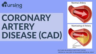 What is Coronary Artery Disease? And how do you treat it as a Nurse? (Nursing School Lesson)