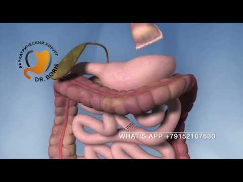 Видео: Как подготовиться к операции обходного желудочного анастомоза (с иллюстрациями)