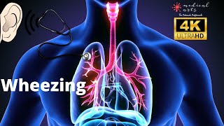Lung Sounds | Expiratory Wheezing Sound  | Abnormal Breath Sounds | Adventitious Sounds