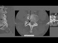 How to Read the CT Scans | How to Read CT Myelograms | How to Read Spine Imaging