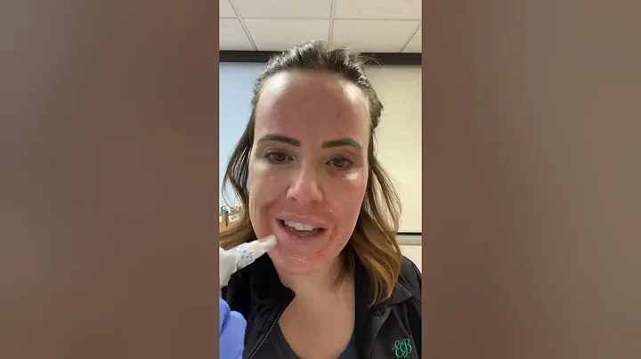 Microneedling with Skin Pen