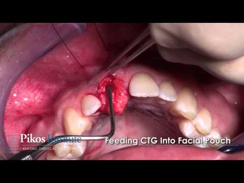 Pedicle Tunnel Connective Tissue Graft PTCTG Instruction Video