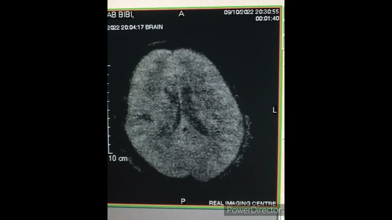 DWI on open MRI system|| stroke protocol