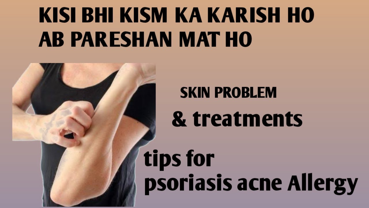 karish Allergy ka desi ilaj YouTube