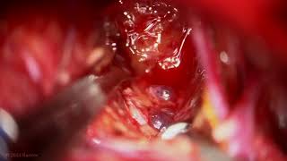 Extended Retrosigmoid & Trans-MCP Approach for Peduncular Pontine Cavernous Malformation Resection