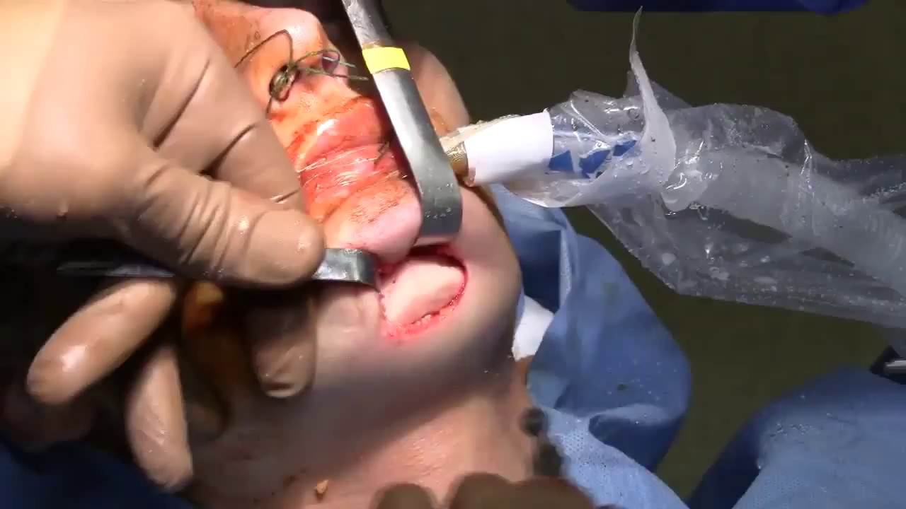 Chin Reduction with Dr. Miller