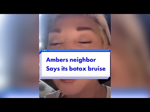 Amber's Neighbor Says It's BOTOX bruise