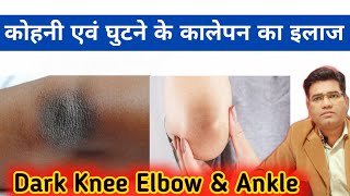 Skin Lightening Treatment for Dark Knee & Elbow