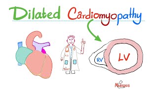 Dilated (Congestive) Cardiomyopathy (Systolic Dysfunction) | Causes, Symptoms, Diagnosis, Treatment