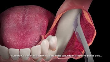 Yxoss Customized Bone Regeneration and Geistlich Biomaterials