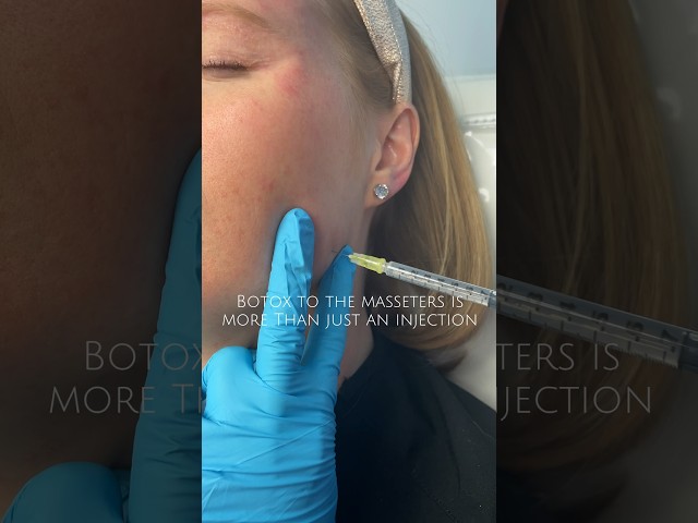 Benefits of Botox to the Masseters! #botox #tmjdisorder #plasticsurgery