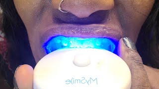 MySmile Dental Whitening kit Deluxe At-Home Whitening System Results in 10 minutes Whiten 10 Shades