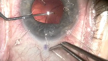 IOL exchange for Intracapsular UGH syndrome by Steven G. Safran MD