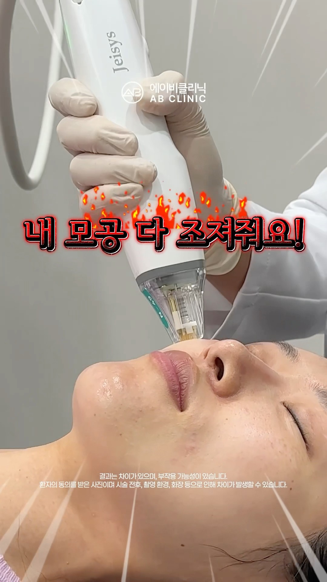 모공 시술 끝판왕🌟