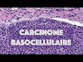 Le carcinome basocellulaire  pathologie