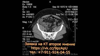 Цирроз печени и асцит выявленные при пересмотре КТ брюшной полости с диска