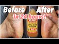 HOW TO REMOVE DEAD SKIN ON YOUR FEET *amazing results in just 24 hours*