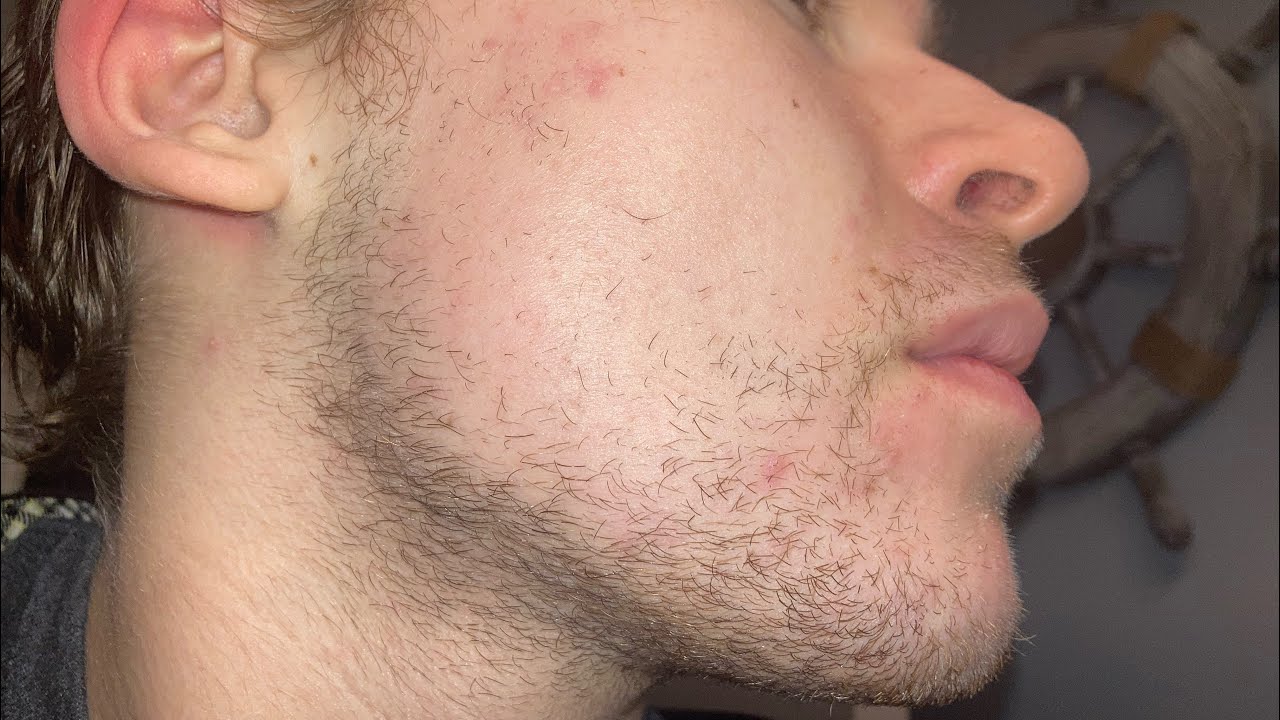 Minoxidil and Derma roller (Year 2) (Week 32) - YouTube