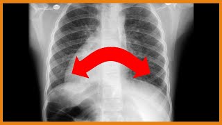 Primary Ciliary Dyskinesia (Kartagener Syndrome) vs. Cystic Fibrosis