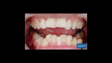 Quá Trình Niềng Răng Diễn Ra Thế Nào? | Mô Phỏng Quá Trình Niềng Răng | Minh Họa Niềng Răng Mắc Cài