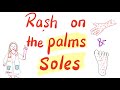 Fever and rash on palms and soles