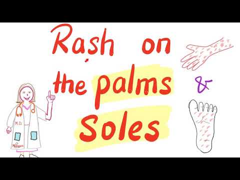 Fever and rash on palms and soles