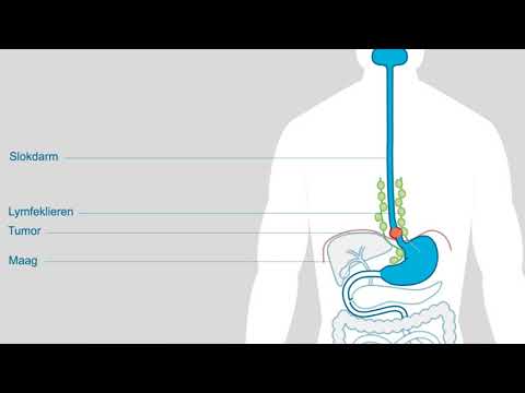 Video: Neerwaartse Regulatie Van MiR-31 Stimuleert Expressie Van LATS2 Via Het Hippopad En Bevordert Epitheliale-mesenchymale Transitie In Slokdarm Plaveiselcelcarcinoom