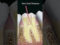 Root canal treatment