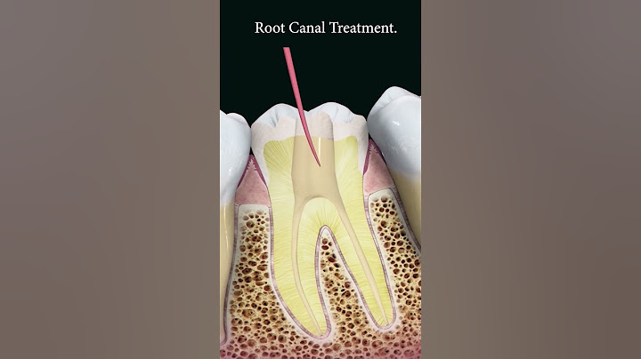 Root canal treatment