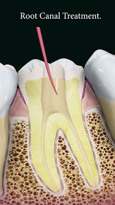 Root canal treatment