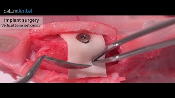 OSSIX VOLUMAX collagen scaffold for GBR MKT0020 03 IFU