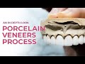 Porcelain Veneers A Dental Boutique Process | An In Depth Look