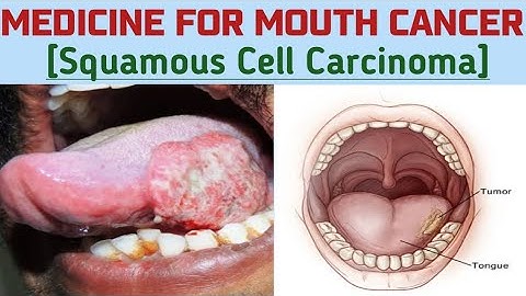 Moderately differentiated squamous cell carcinoma of tongue