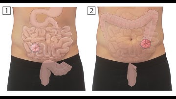 Ileoscopy CPT code - simplify medical coding