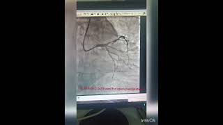 angiography lad coronaryarteries angioplasty  stenting