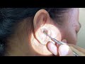 Massive hard dry earwax removed from womans ear