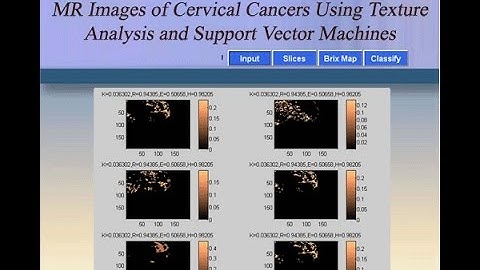 Cervical Cancer Image Classification Using Texture Analysis and SVM Matlab Project