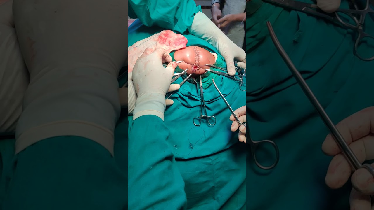 Post Sagittal anorectoplasty