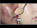 How To Get Rid of Hyperpigmentation - Freckles, Dark Spots, Melasma, Black Patches Fast Naturally