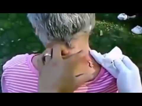 Top cystic acne, blackheads, acne horror squeeze On Back 