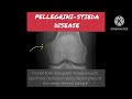 Pellegrini Stieda disease