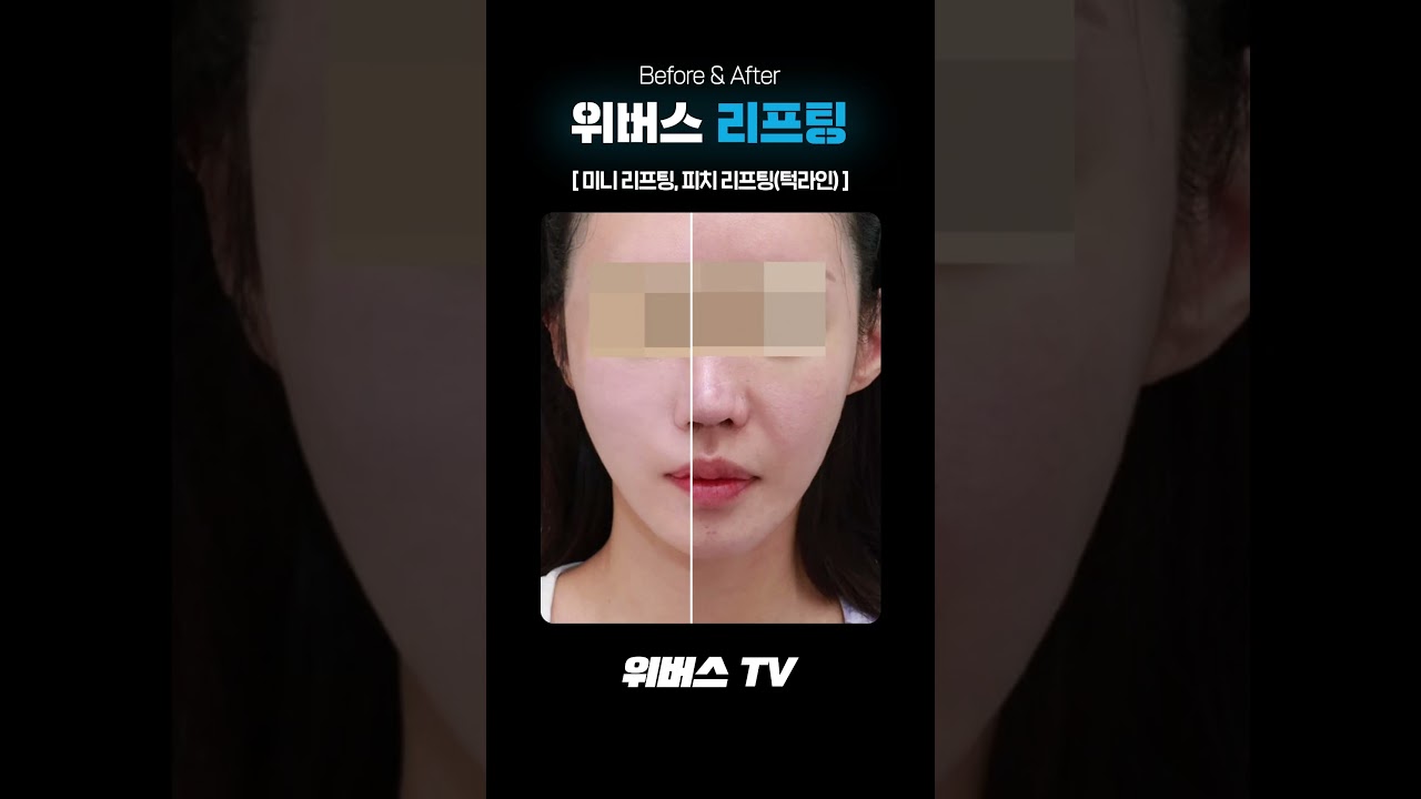 [Вивэрс гоо сайхны мэс заслын эмнэлэг] Мини лифтингээр нүүр өргөлтийн үр дүнг аваарай!