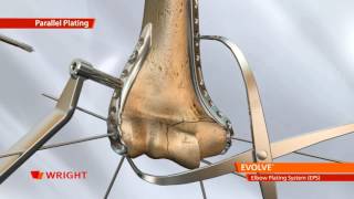 EVOLVE™ EPS Elbow Plating System