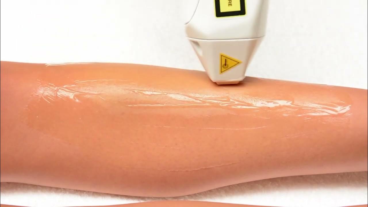 Diode Laser Hair Removal (XLASE) & Skin Rejuvenation YouTube