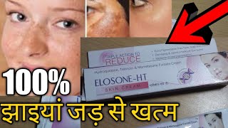 Elosone Ht Skin Cream Review Pigmentation Melasma And Darkness Reduction Cream Review Sg Support Youtube