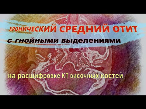 Двухсторонний МАСТОИДИТ (хронический СРЕДНИЙ ОТИТ) с гнойными ВЫДЕЛЕНИЯМИ ИЗ УХА на расшифровке КТ